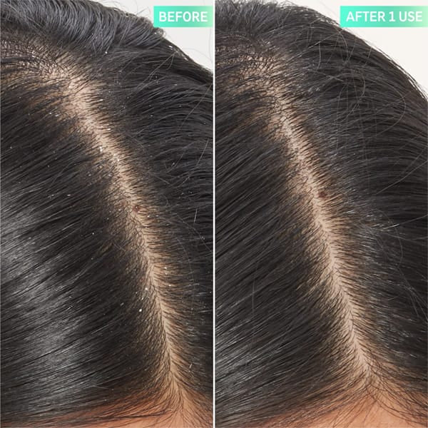 The Inkey List salicylic acid exfoliating scalp treatment 150ml