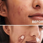 Neutrogena® Oil-Free Acne Wash Pink Grapefruit Facial Cleanser 177ml